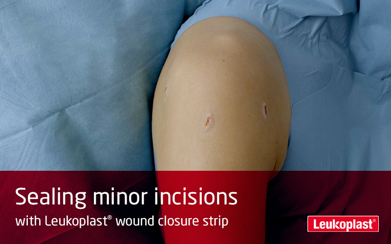 Here we can see in a close-up how minor incisions are treated using wound closure strips: we see an HCP sealing three small cut wounds on a patient's shoulder with the help of Leukoplast wound closure strip. Here we can see in a close-up how minor incisions are treated using wound closure strips: we see an HCP sealing three small cut wounds on a patient's shoulder with the help of Leukoplast wound closure strip.